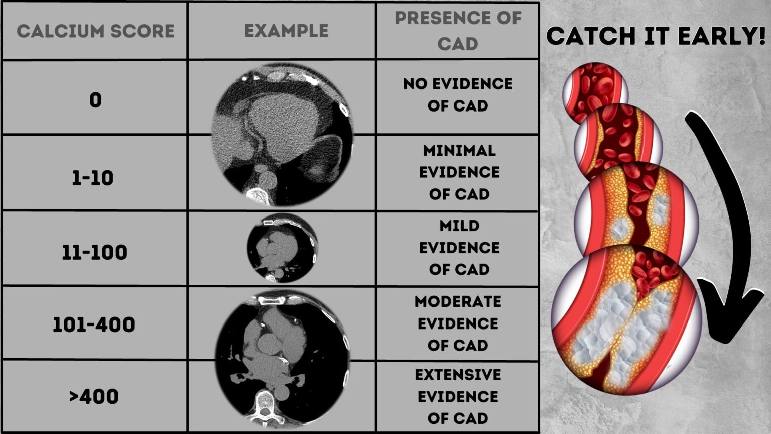 Why No Caffeine Before Calcium Scoring? Answered!